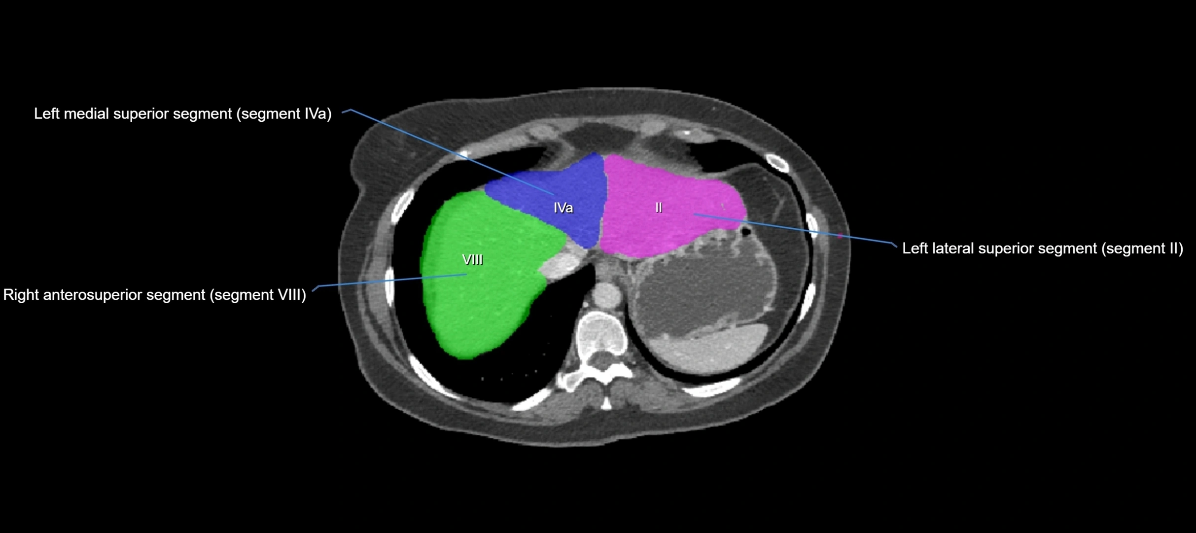 CT liver segments axial cross sectional anatomy labelled image-00068.webp